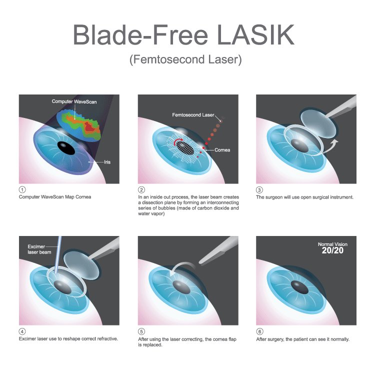 FEMTOSECOND LASER (Blade-Free LASIK)