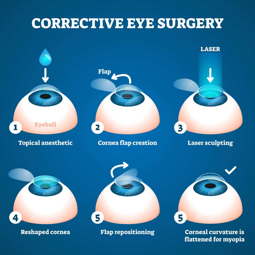 Step-by-Step: How LASIK Surgery Works