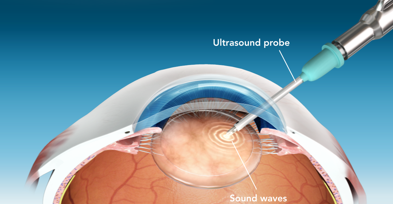 How Cataract Surgery Works – The Triple-E Approach