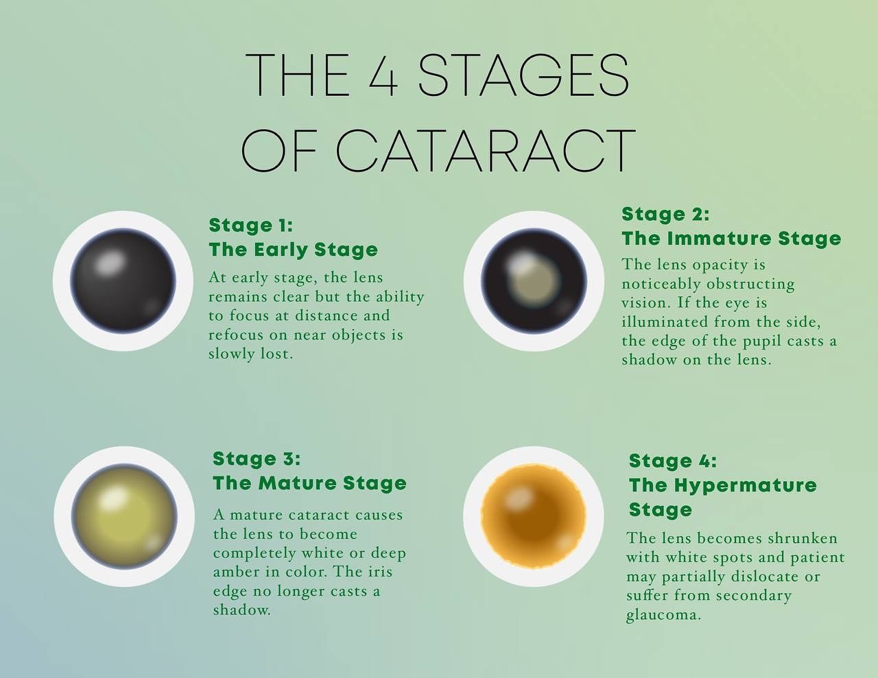 When Should You Consider Cataract Surgery?