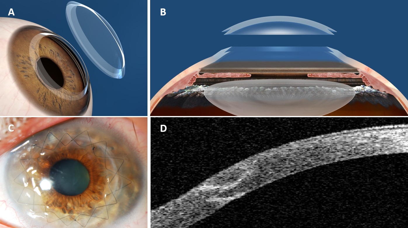 Optical Keratoplasty