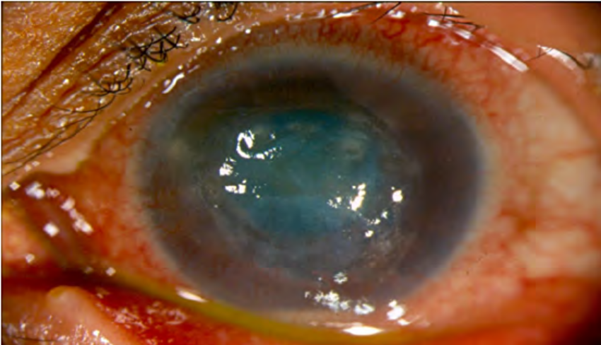 Therapeutic Keratoplasty