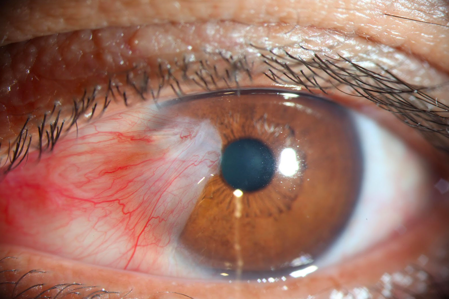 Pterygium Surgery