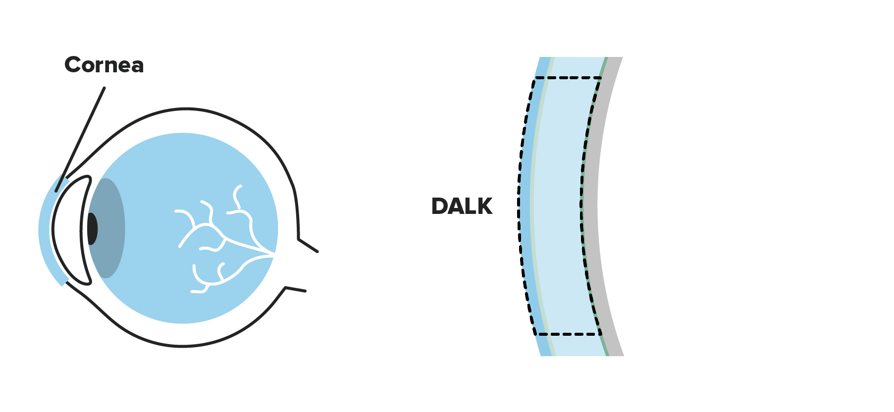 DALK