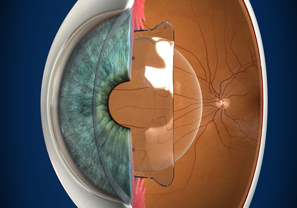 ICL (Implantable Collamer Lens)