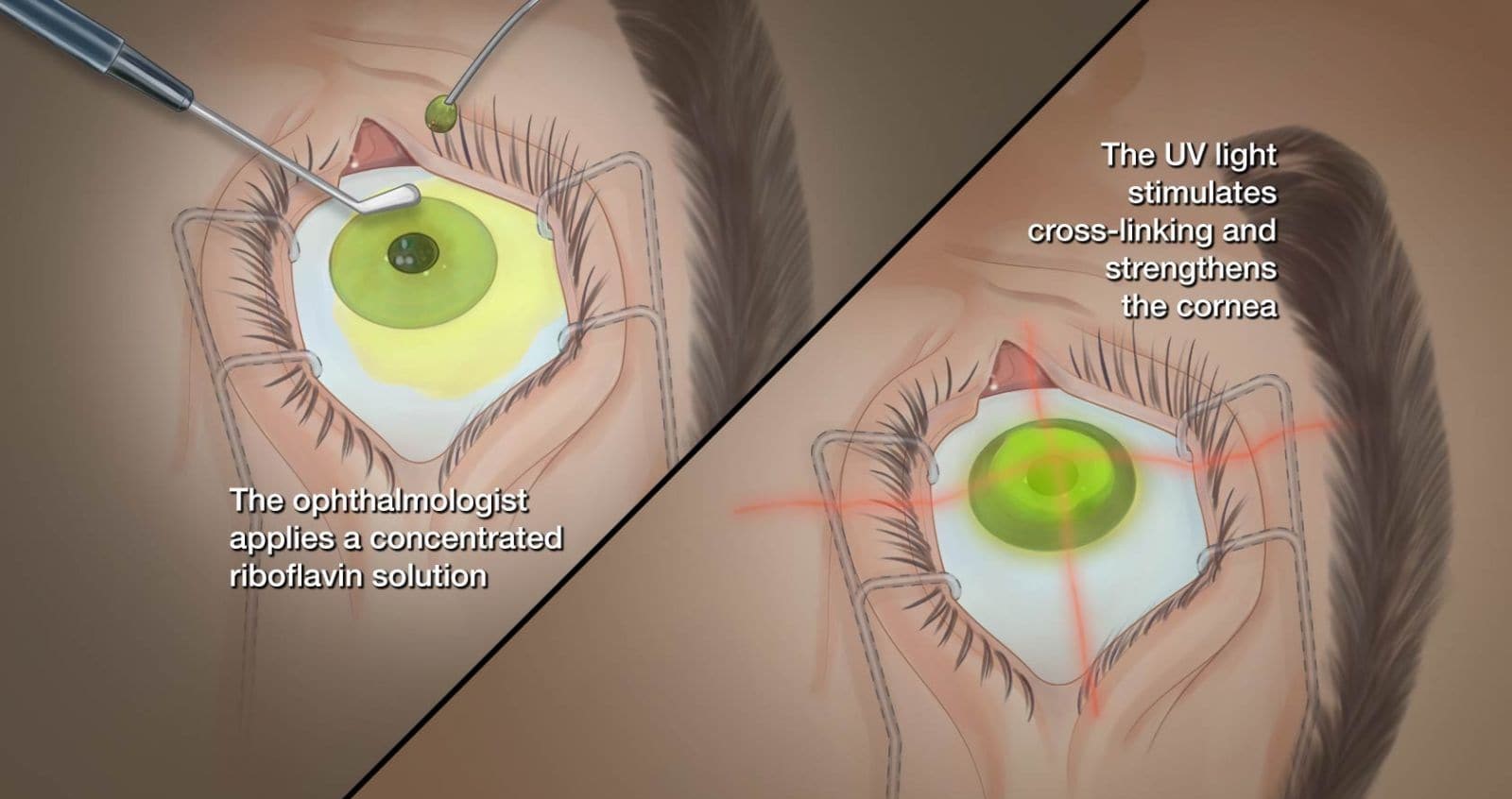Corneal Collagen Cross Linking (CXL/C3R)